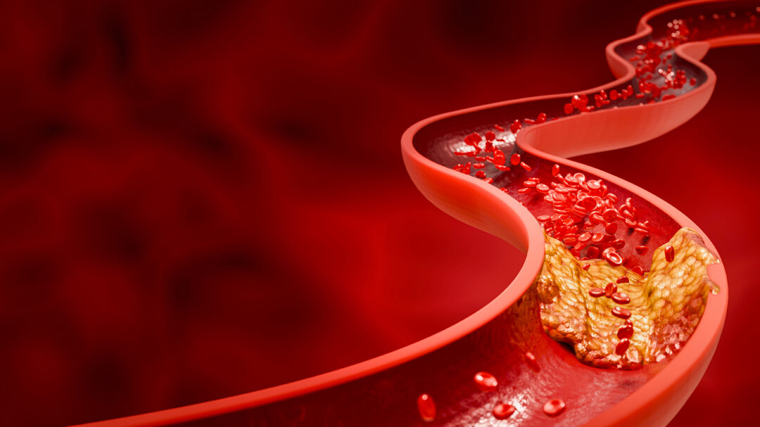 χαμηλή-ldl-και-εγκεφαλικό-μια-προσεκτικ-563815651