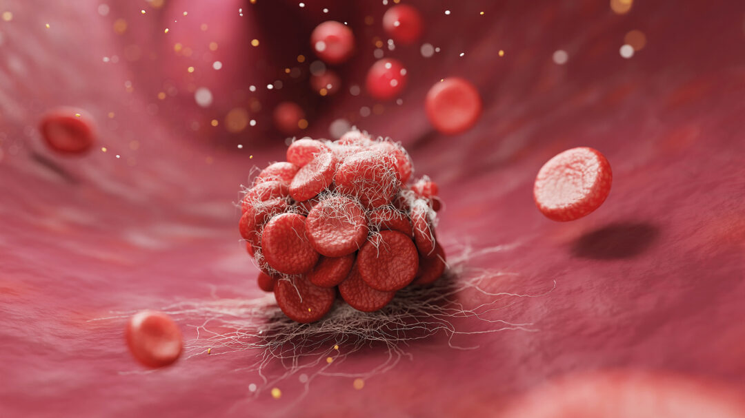 τι-νεότερο-υπάρχει-στην-πρόληψη-της-θρ-563854528