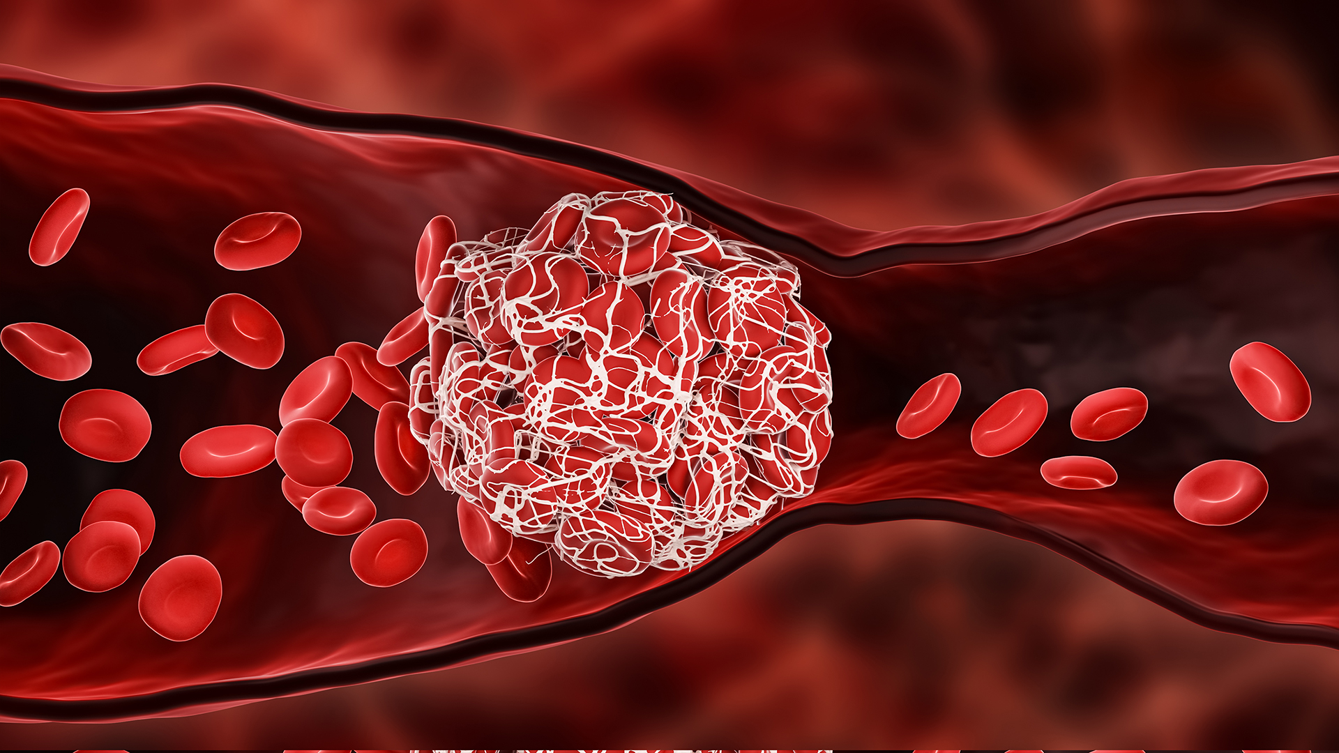 Τι νεότερο υπάρχει στην πρόληψη της θρόμβωσης-1