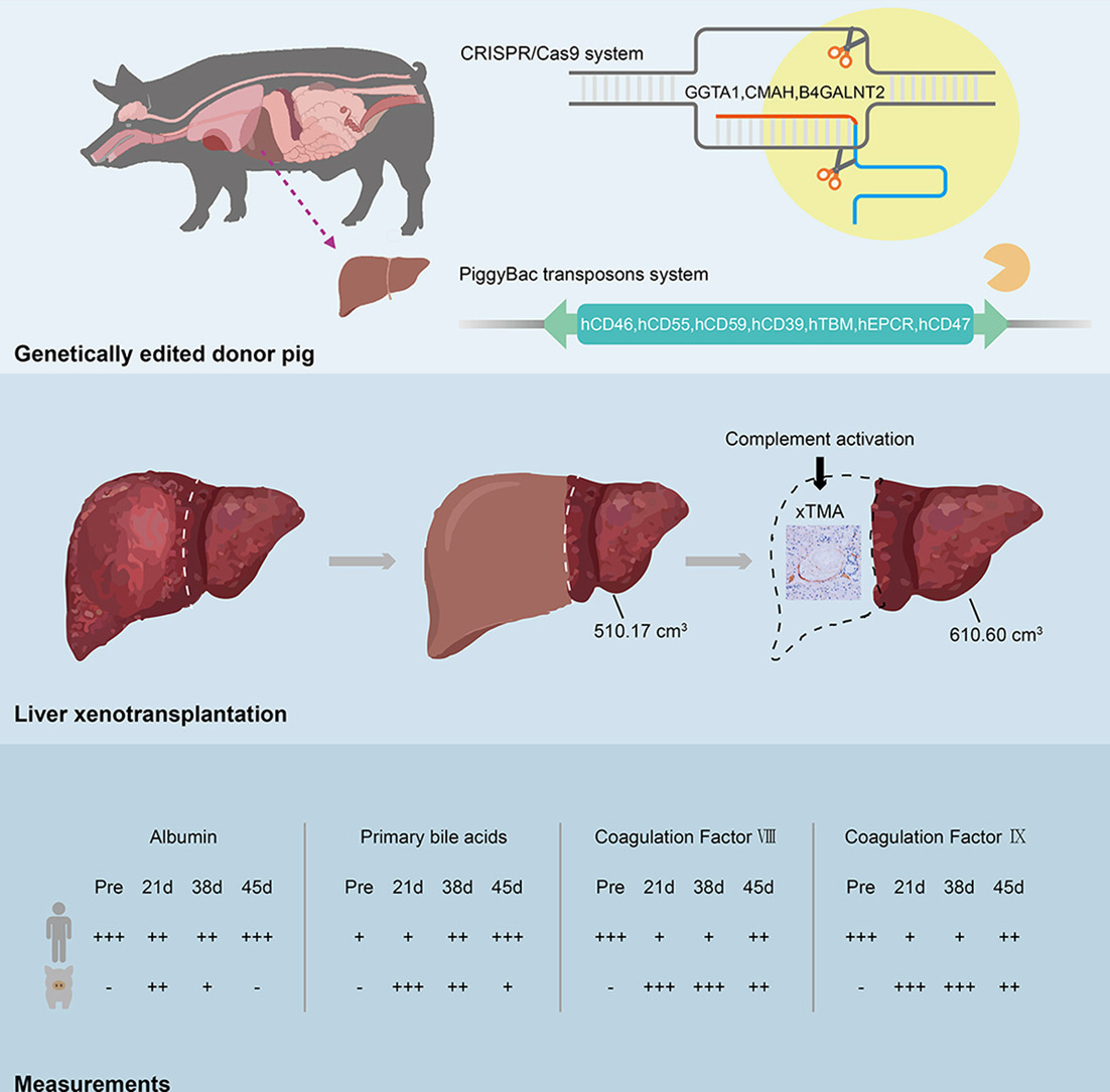 Πώς έγινε η πρώτη μεταμόσχευση ήπατος από χοίρο σε άνθρωπο – Ο ασθενής επέζησε για 171 ημέρες-1