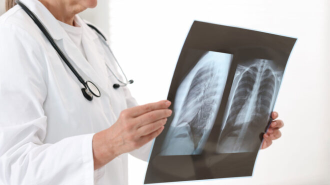 ο-καρκίνος-του-πνεύμονα-δεν-είναι-αποκ-563896402