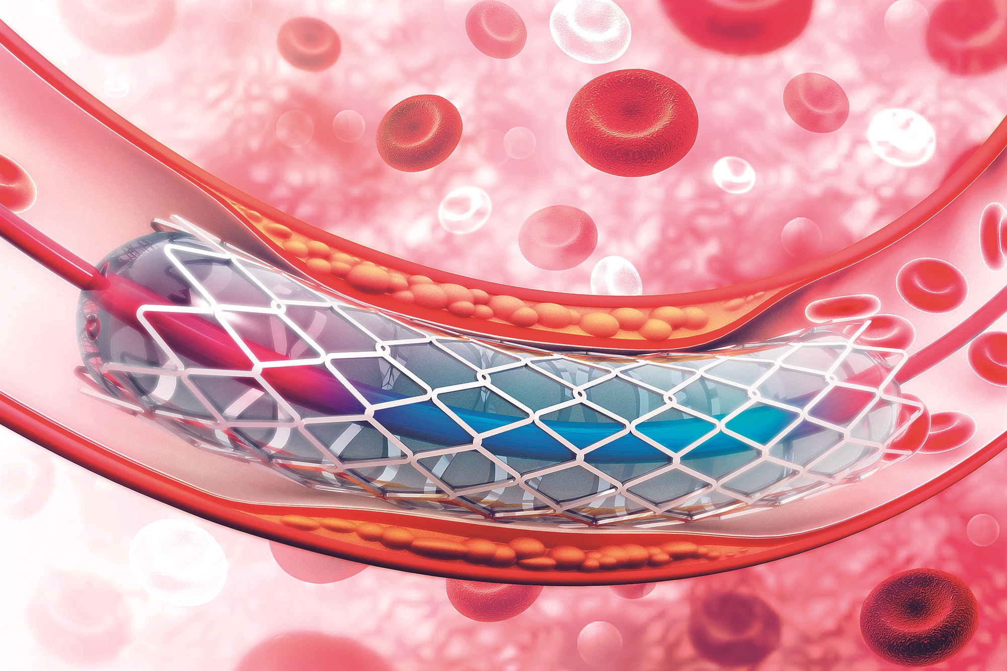Πότε πραγματικά χρειάζονται η αγγειοπλαστική και οι ενδοπροθέσεις;-4