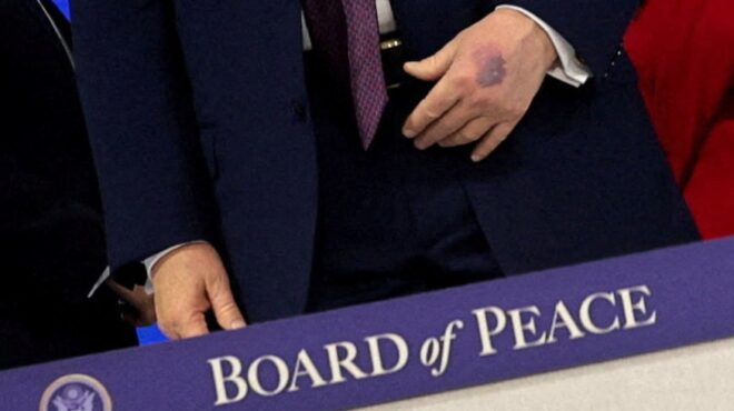 με-νέο-μώλωπα-στο-χέρι-εμφανίστηκε-ο-τρ-564038098