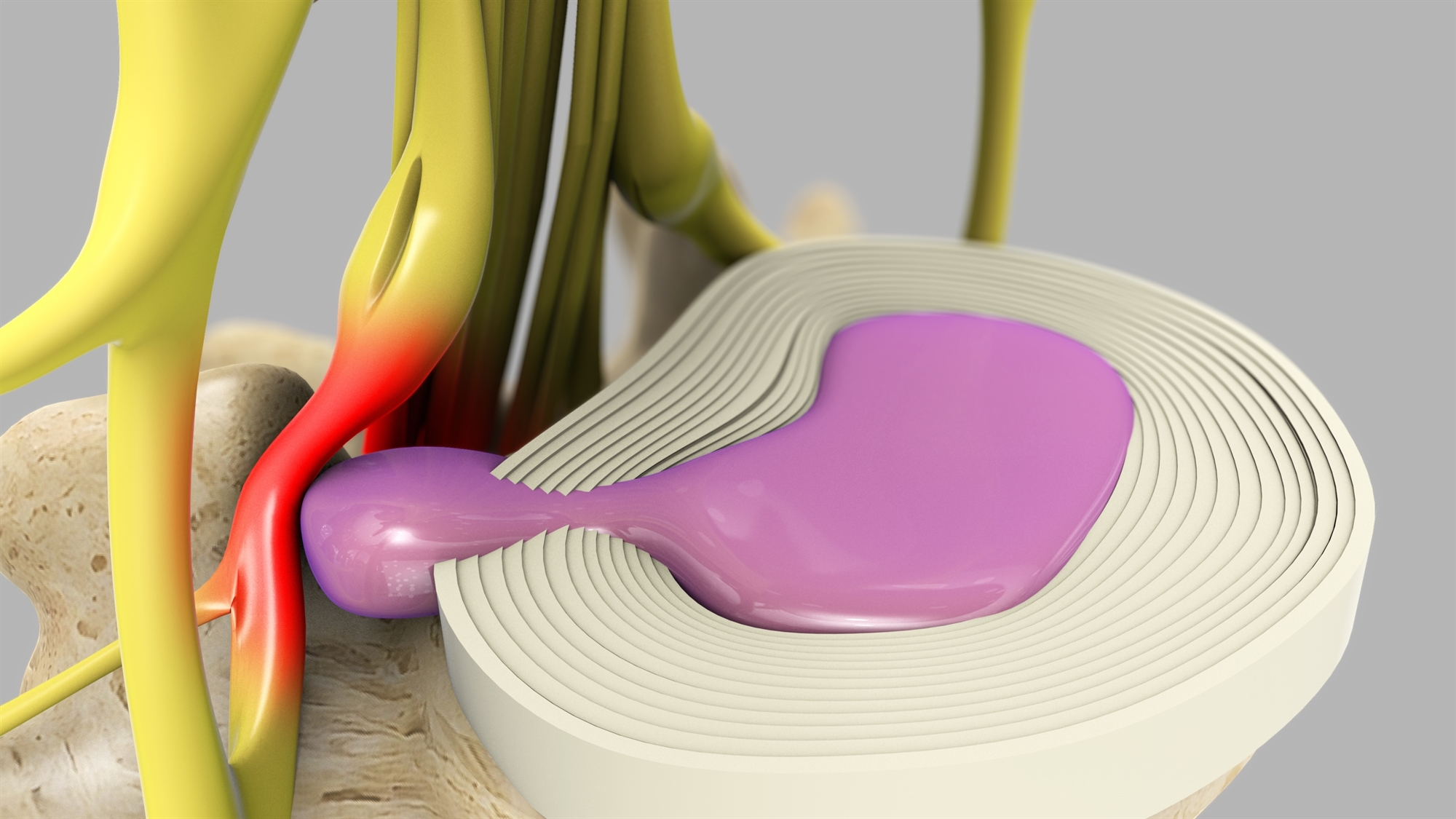 Αντιμετωπίστε δυναμικά τα «πιασμένα» νεύρα-7