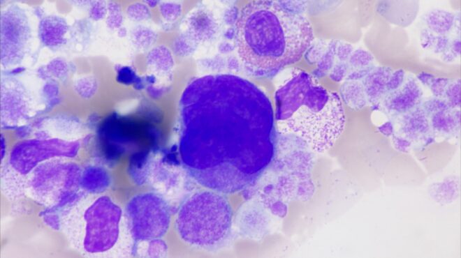 αύξηση-αιματολογικών-καρκίνων-έπειτ-564162577